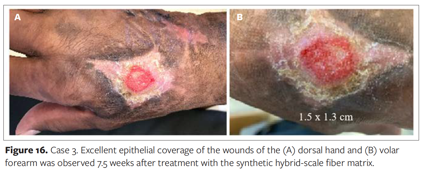 Synthetic Hybrid-Scale Fiber Matrix in Trauma Surgical Practice